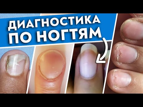 Видео: Как определить болезнь по ногтям? | Ногти скажут всё о вашем здоровье!