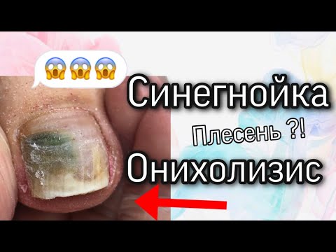Видео: Под покрытием плесень ? Педикюр / онихолизис / отслоение ногтя / синегнойка на ногте /что мы сделали