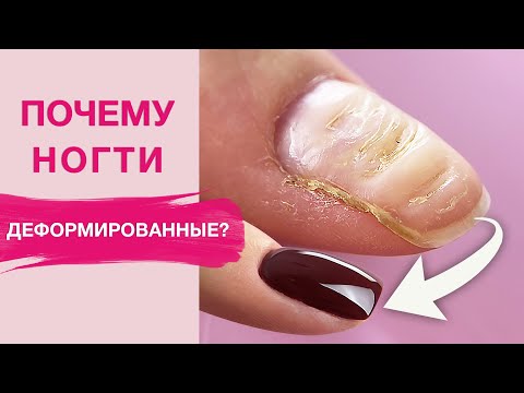 Видео: ДЕФОРМИРОВАННЫЕ ногти? Исправляем и делаем укрепление полигелем