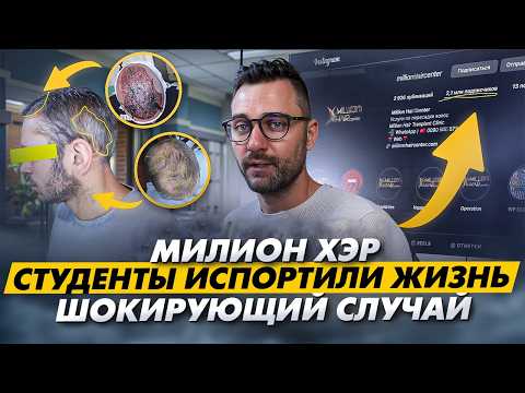 Видео: КОШМАР после конвейерной пересадки волос | Реальный случай из Milion Hair | KRASAV4IK