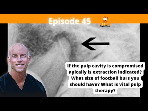Видео: Эп. 45 - Если полость пульпы повреждена апикально, показано ли удаление?