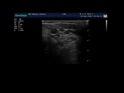 Видео: УЗИ Щитовидной железы. Пациент 5