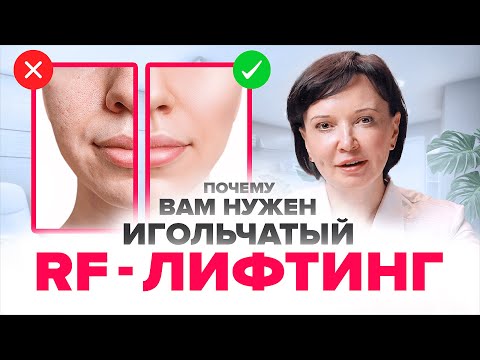 Видео: ИГОЛЬЧАТЫЙ RF ЛИФТИНГ. Почему после 35 лет он нужен всем, а кому-то даже раньше | Ирина Рахова