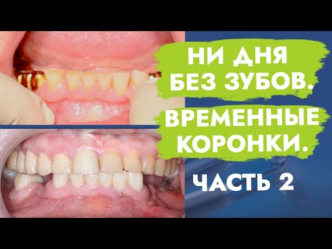 Видео: Ни дня без зубов. Временные коронки. Часть 2