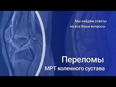 Видео: МРТ коленного сустава. Переломы