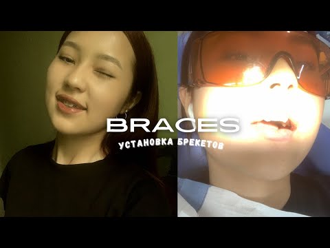 Видео: Больно, страшно, дорого? Вся правда о моих брекетах 🫩😢 || men_elita