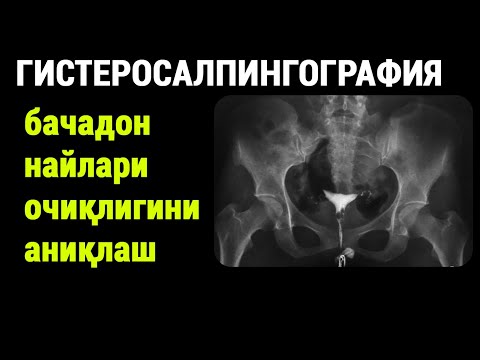 Видео: Гистеросалпингография: бачадон найлари очиқлигини аниқлаш