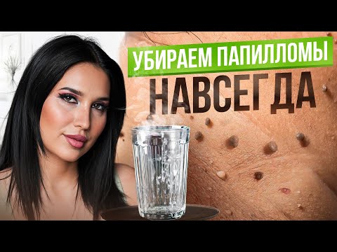 Видео: 3 простых способа избавиться от папиллом в домашних условиях