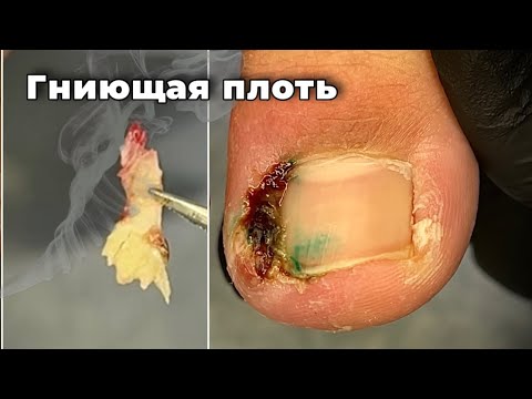 Видео: Пол года гнило и врастало. Зажило за 4 дня