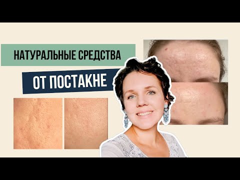 Видео: Как убрать следы от прыщей | эффективные средства от рубцов и постакне