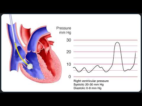 Видео: Установка катетера в легочную артерию (Сван-Ганца)