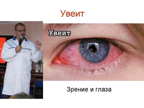 Видео: Увеит – аутоиммунное воспаление глаза. И его лечение.