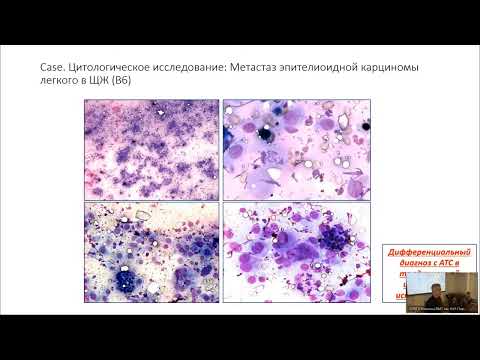 Видео: Морфологические аспекты анапластического рака щитовидной железы. Иммуногистохимические предикторы