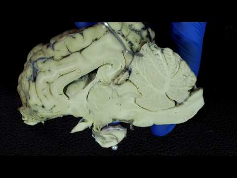 Видео: мозжечок. 4-й мозговой желудочек.