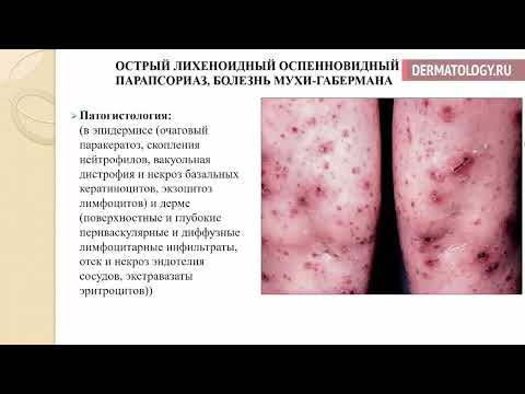 Видео: Парапсориаз (доклад д.м.н. Сорокиной Е.В.)