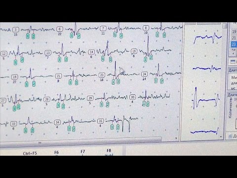Видео: Игольчатая миография (ЭМГ). Практическое занятие