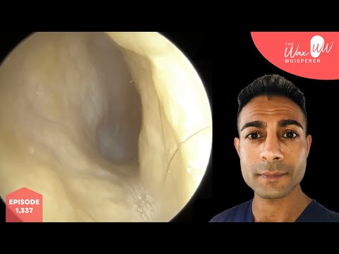 Видео: 1,337 - Постинфекционные остатки и отмершая кожа уха