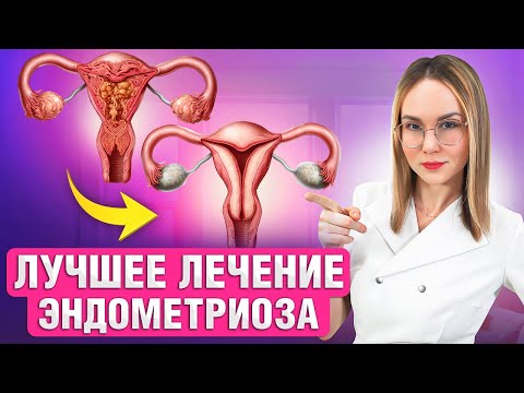 Видео: Эндометриоз. Можно ли избавиться НАВСЕГДА?