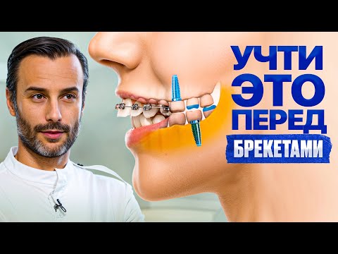 Видео: 5 рекомендаций ортодонта перед установкой брекетов