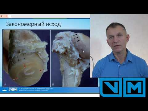 Видео: Дисплазия тазобедренного сустава как лечить