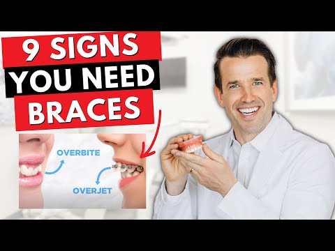 Видео: 9 признаков того, что вам нужны брекеты | Перекрытие зубов, неправильный прикус, скученность...