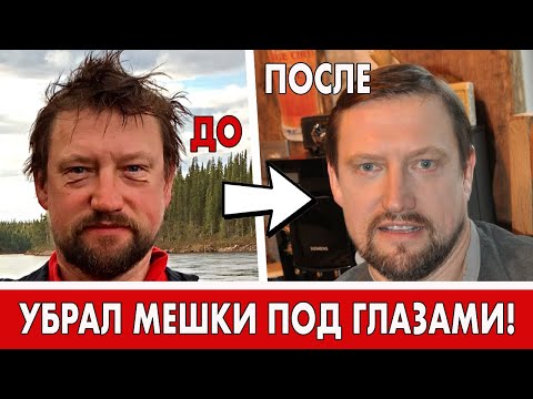 Видео: БЛЕФАРОПЛАСТИКА ДО И ПОСЛЕ! УБРАЛ МЕШКИ ПОД ГЛАЗАМИ !
