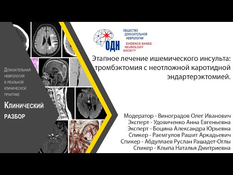 Видео: Этапное лечение ишемического инсульта: тромбэктомия с неотложной каротидной эндартерэктомией.