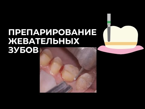 Видео: ПРЕПАРИРОВАНИЕ ЖЕВАТЕЛЬНЫХ ЗУБОВ коронка две накладки