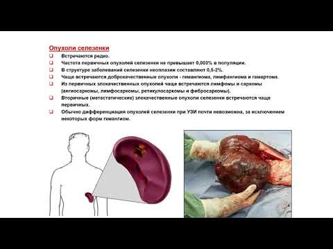Видео: Ультразвуковая диагностика (УЗИ). Доктор Иогансен. Выпуск 65. Опухоли селезенки.