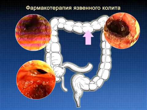 Видео: Фармакотреапия язвенного колита © Pharmacotreapia of ulcerative colitis