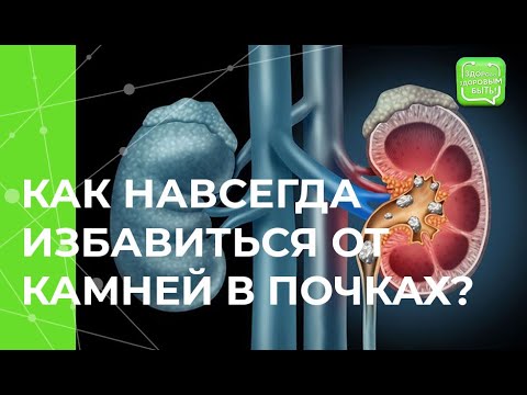 Видео: Камни в почках: полезные привычки предотвращения болезни