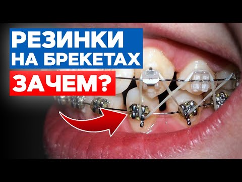 Видео: Зачем нужны ЭЛАСТИКИ? | Сколько носить резинки с брекетами?
