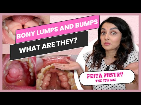 Видео: Костные уплотнения и шишки — что это такое?