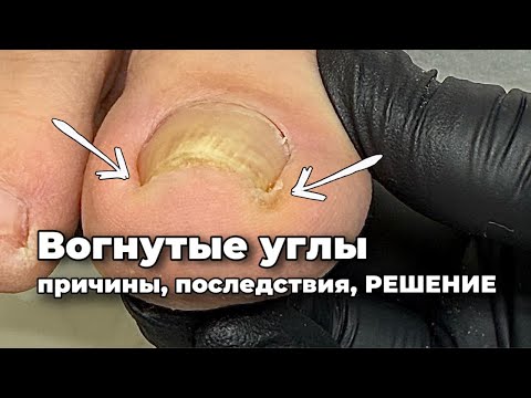 Видео: Как разрушить монолит боковой стенки. Углы по направлению к центру ногтя