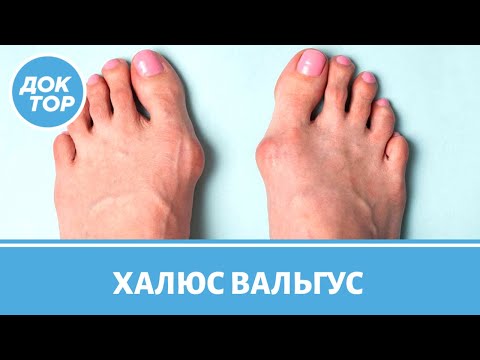Видео: Растет косточка на ноге – что делать?