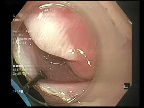 Видео: Эндоскопическое лечение большого дивертикула Ценкера