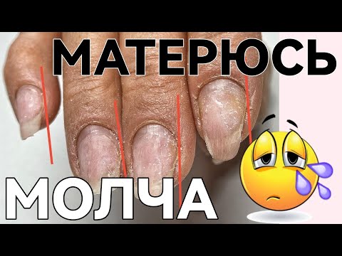 Видео: СЛОЖНАЯ КОРРЕКЦИЯ / спиленные боковые стенки / клюющие ногти / маникюр от другого мастера до и после