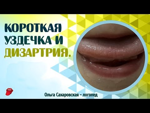 Видео: Как понять, короткая уздечка языка или нет? Дизартрия, уздечка языка и звукопроизношение.