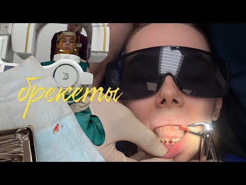 Видео: БРЕКЕТЫ: 3 ГОДА СПУСТЯ ♡ ИТОГИ, УДАЛЕНИЕ ПЕРЕДНЕЙ ЕДИНИЦЫ, ПРОБЛЕМЫ С СУСТАВОМ