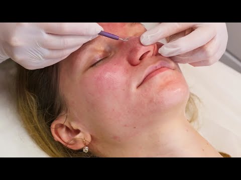 Видео: Комплексная чистка лица. Как добиться идеальной кожи?