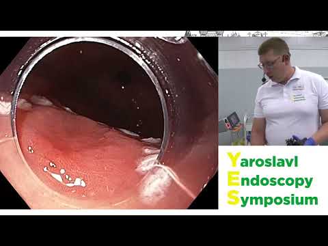 Видео: Эндоскопическая диссекция раннего рака желудка. К. Шишин