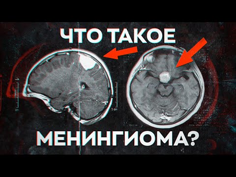 Видео: Что такое менингиома?