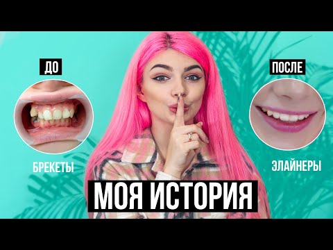 Видео: Моя История Выпрямления Зубов 😬  Удаление, Брекеты, Элайнеры, Импланты | До и После + Ответы