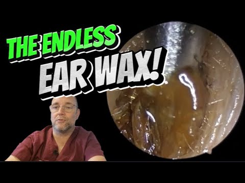 Видео: БЕСКОНЕЧНАЯ УШНАЯ СЕРА! 296 #ухо #ушнаясера #удалениеушнойсеры #чисткаушей #длявас #асмр #fyp #уд...
