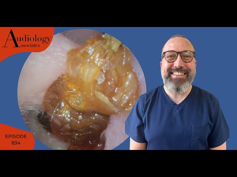 Видео: 3 процедуры удаления кератина, включая предкератотические обтурационные процедуры EP834