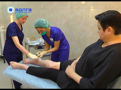 Видео: Трофические язвы при варикозе