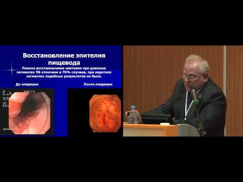 Видео: Лапароскопическое лечение гастроэзофагеальной рефлюксной болезни, осложненной пищеводом Барретта