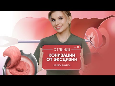Видео: В чем отличие конизации от эксцизии шейки матки