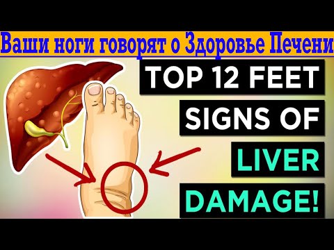 Видео: Если у вас есть эти симптомы, срочно действуйте! Ваши ноги говорят, о здоровье печени!