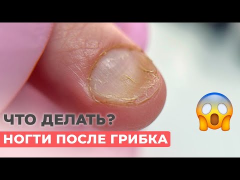 Видео: Грибок ногтей | Можно ли делать покрытие гель лаком?